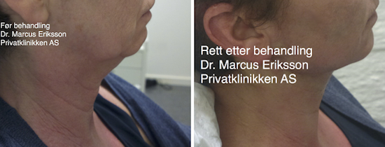 Ansiktsløft uten kirurgi hos Privatklinikken Oslo, Bergen, Stavanger, Kristiansand, Tromsø, Alta