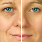 Thermage rynkebehandling for glatt hud (før og etter)
