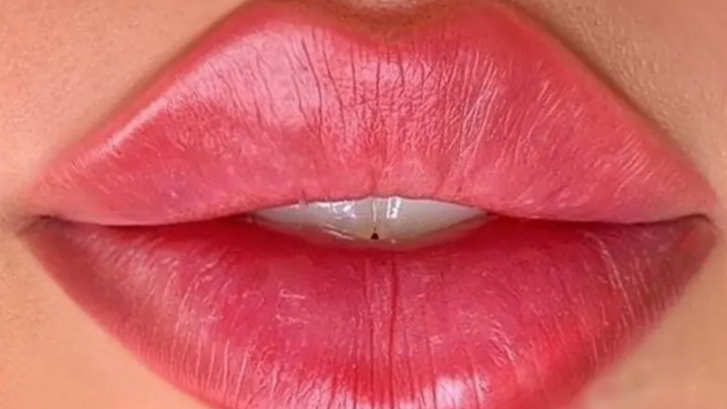 Russian Lips - leppeforstørrelse